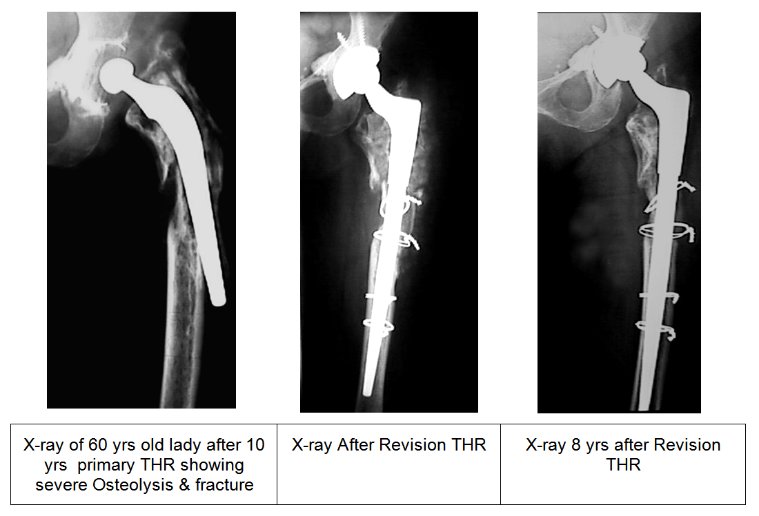 REVISION-TOTAL-HIP-REPLACEMENT-left-1