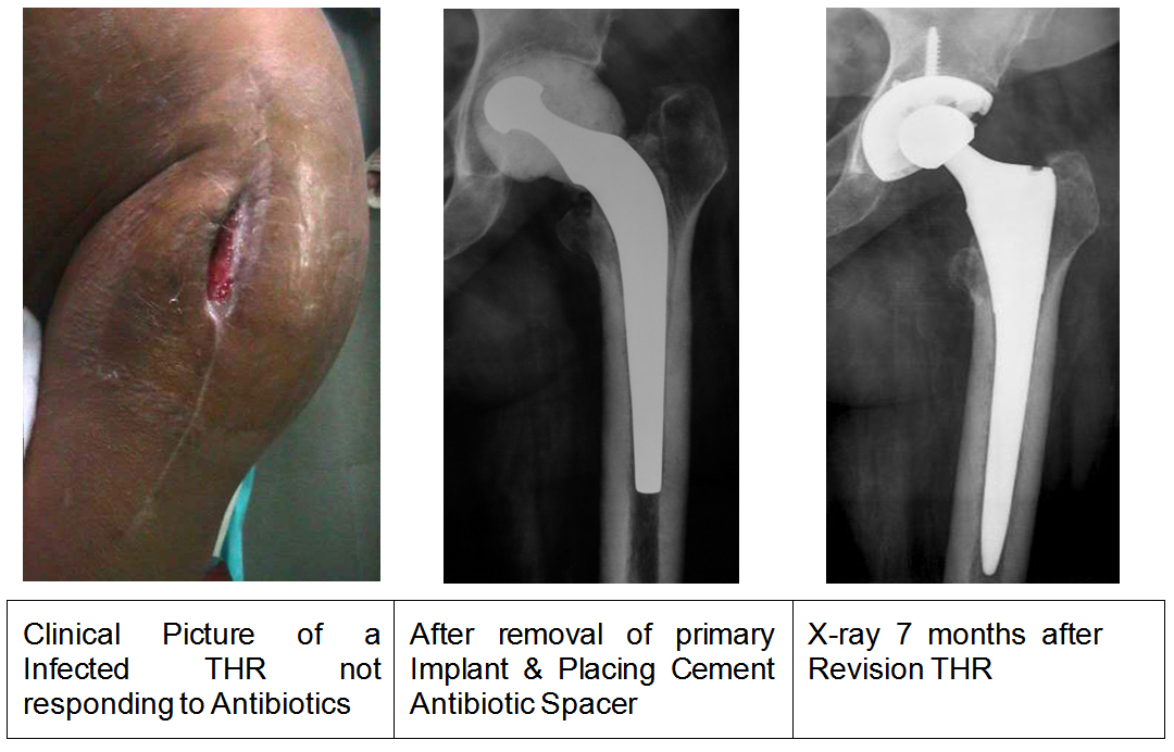 REVISION-TOTAL-HIP-REPLACEMENT-left-2