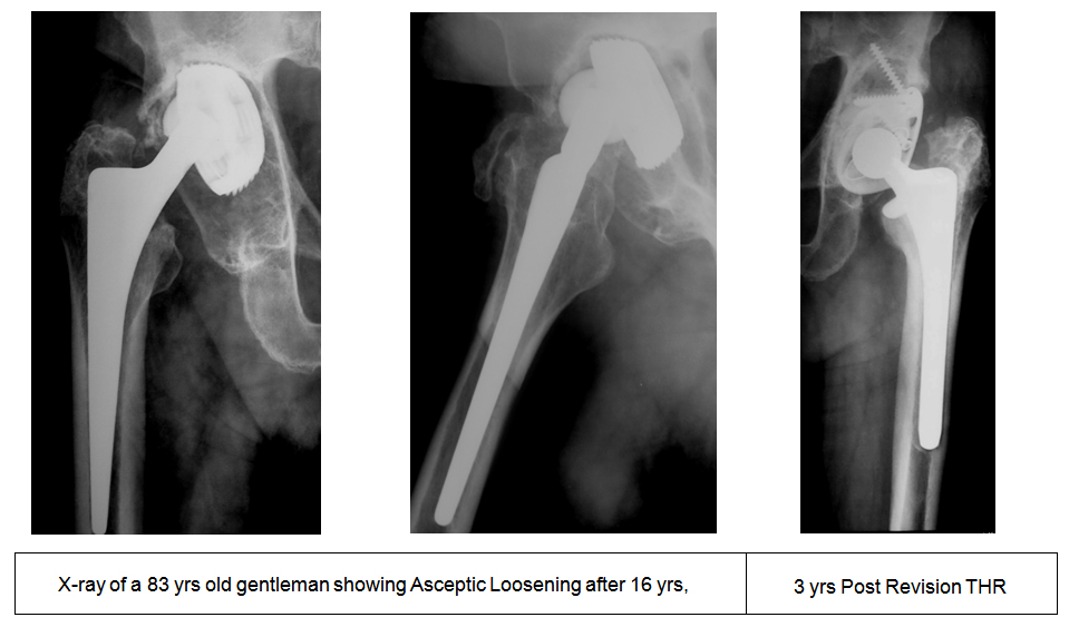 REVISION-TOTAL-HIP-REPLACEMENT-right