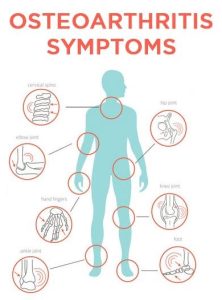 Symptoms of Osteoarthritis Dr Vivek Mittal